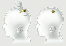 Cómo es Blindsight, el chip de Neuralink que promete devolverle la visión a los ciegos
