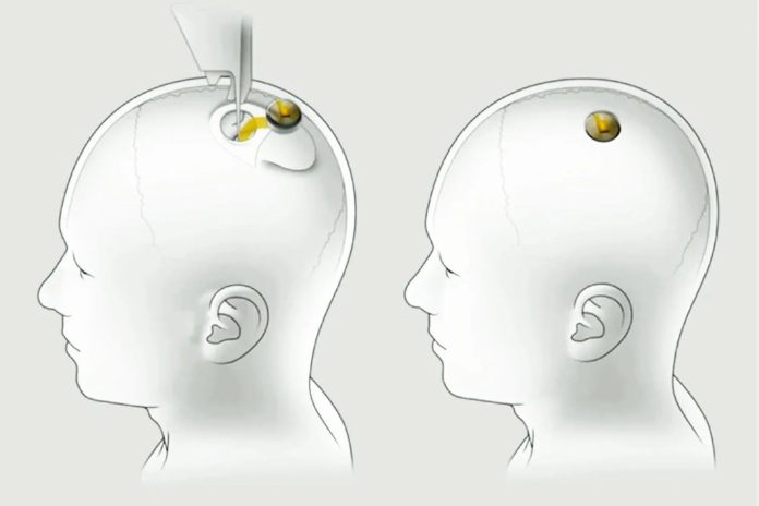 Cómo es Blindsight, el chip de Neuralink que promete devolverle la visión a los ciegos