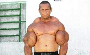 Murió “Popeye”, el fisicoculturista brasileño que se inyectaba aceite para tener unos bíceps de 73 centímetros