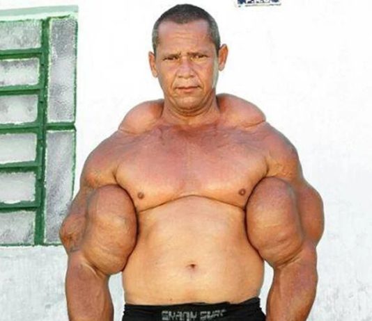 Murió “Popeye”, el fisicoculturista brasileño que se inyectaba aceite para tener unos bíceps de 73 centímetros
