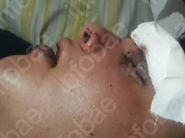 “Se ahogaba con su sangre”, el crudo relato de la novia del joven que denunció una agresión en un boliche de San Telmo