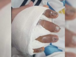 “Tiene el 95% de la mano destruida”: la mamá de un alumno accidentado en una escuela de Jujuy denunció abandono